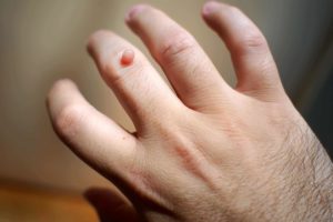 طريقه علاج الثالول