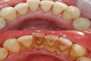 ازالة الجير من الاسنان