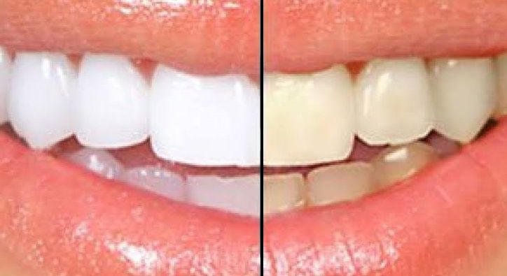 نصائح تنظيف الأسنان من الجير الاصفر بشكل نهائي