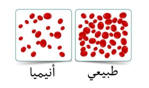 كيفية علاج الانيميا عند الاطفال