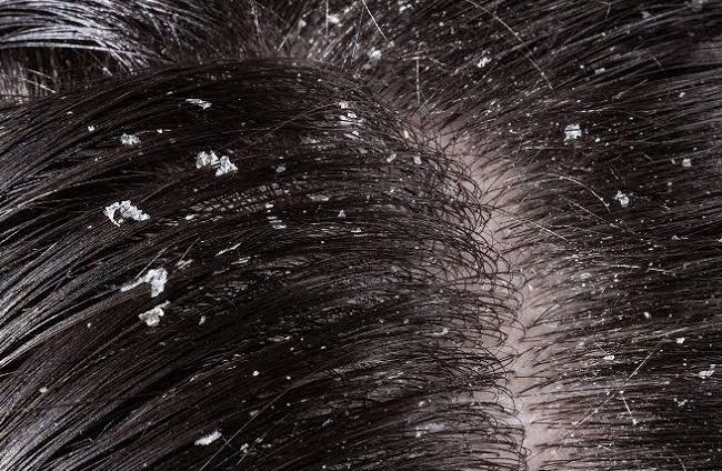 ما هي طريقة علاج قشرة الشعر