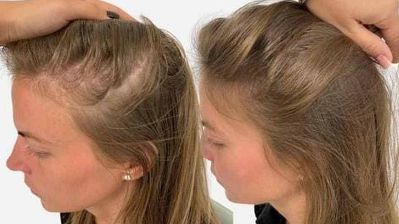 علاج تساقط الشعر مضمون 100