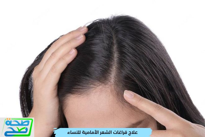 علاج فراغات الشعر الأمامية للنساء ب8 طرق مختلفة
