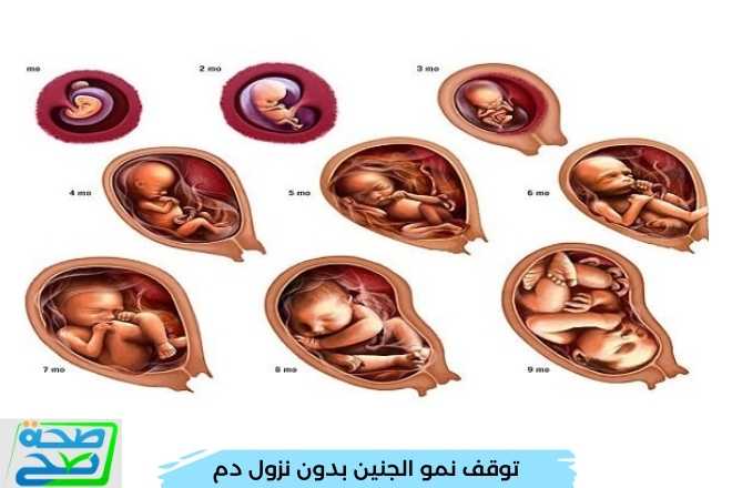 توقف نمو الجنين بدون نزول دم و17 سبب لتوقف النبض