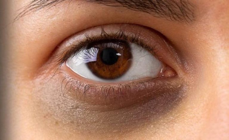 علاج الهالات السوداء تحت العين قبل العيد بـ 3 طرق