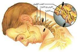 علاج الانزلاق الغضروفي في الرقبة – دكتور أحمد بكير