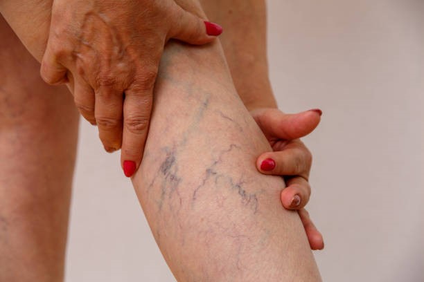 علاج دوالي الساقين بالليزر| دكتور حسام المهدى