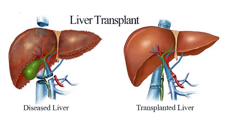 does medicare pay for liver transplants