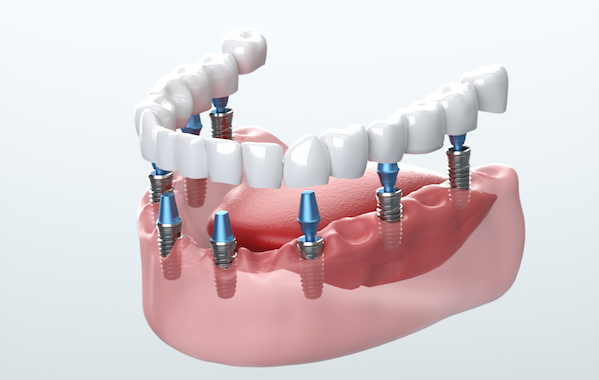 can you use hsa for dental implants