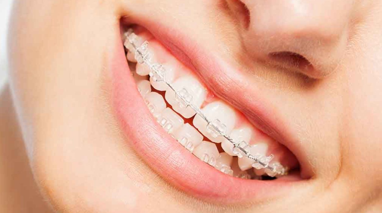 how does orthodontic insurance work