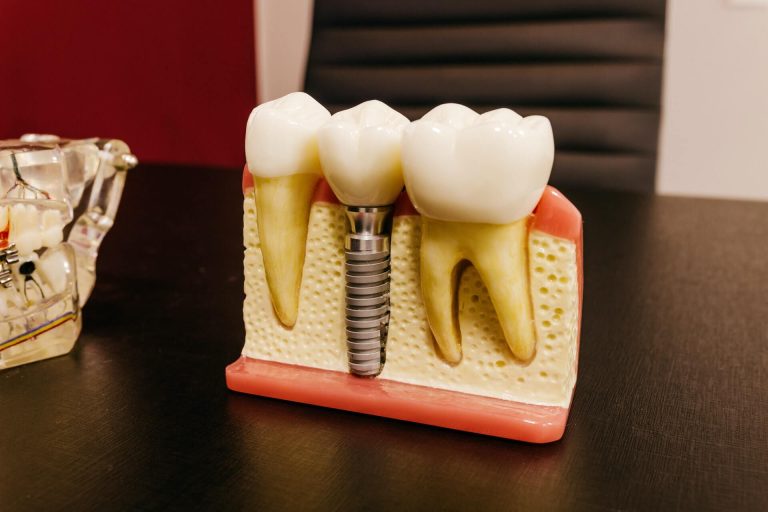 hsa for dental implants