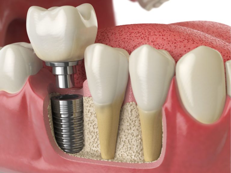 does hsa cover dental implants